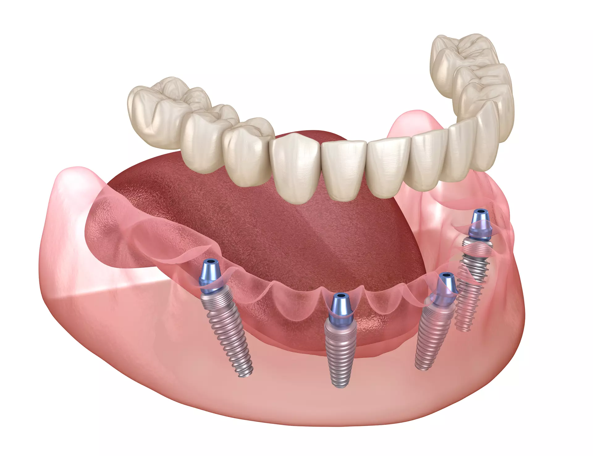 The Dental Implant Procedure