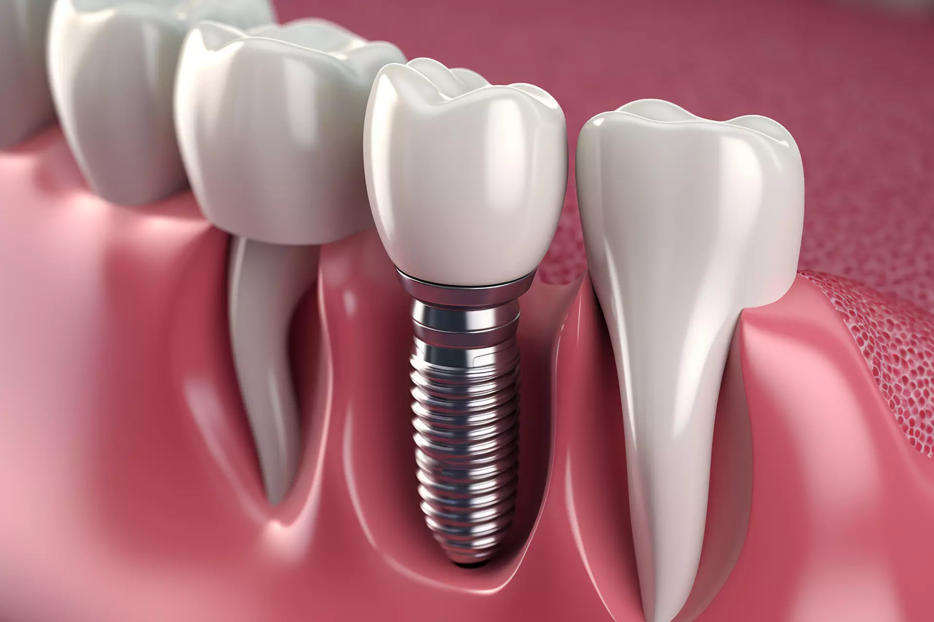 Implants