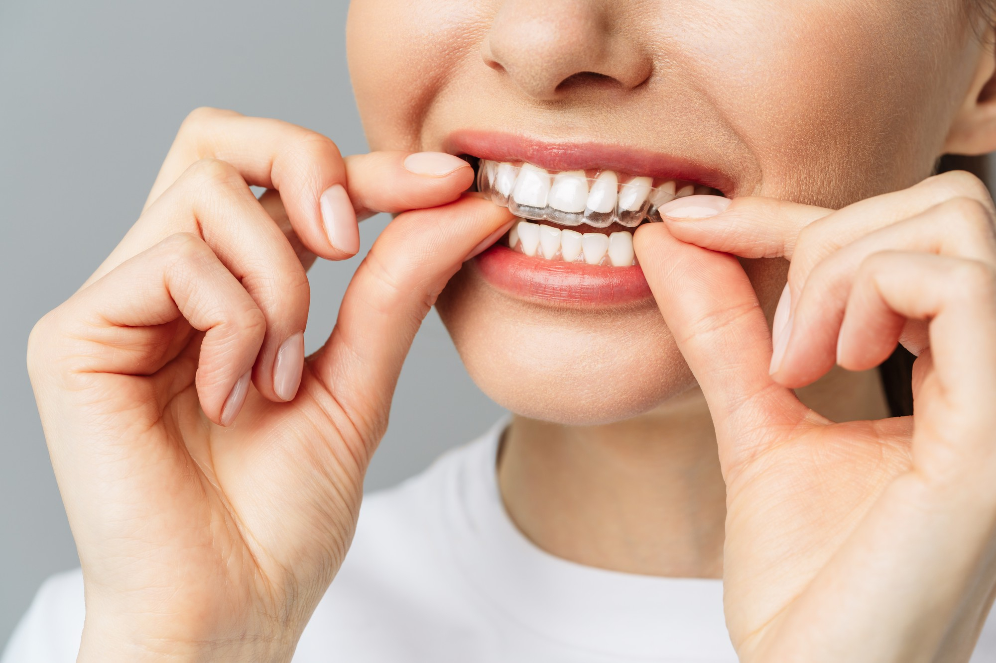 Invisalign®