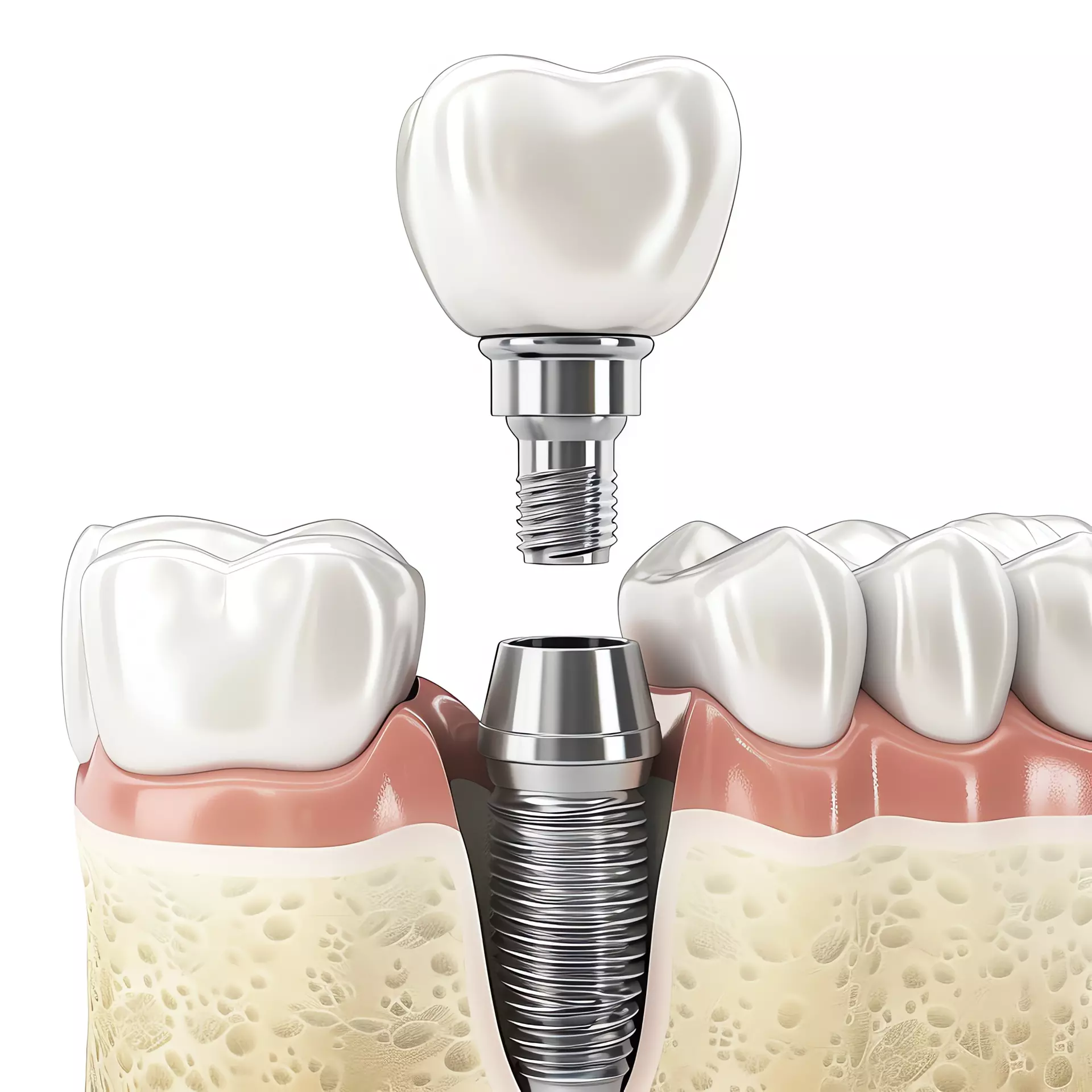 Post-Op Care for Dental Implants